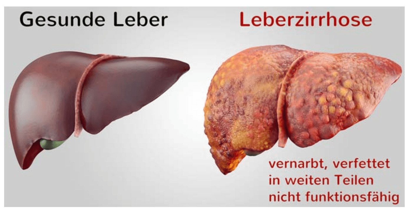 Gesunde und verfettete Leber