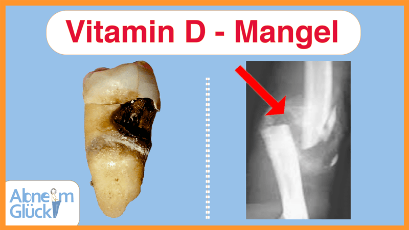 Vitamin D Mangel Symptome